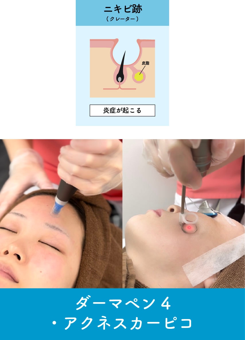 ニキビ跡・クレーター・色素沈着を治すなら「根気」