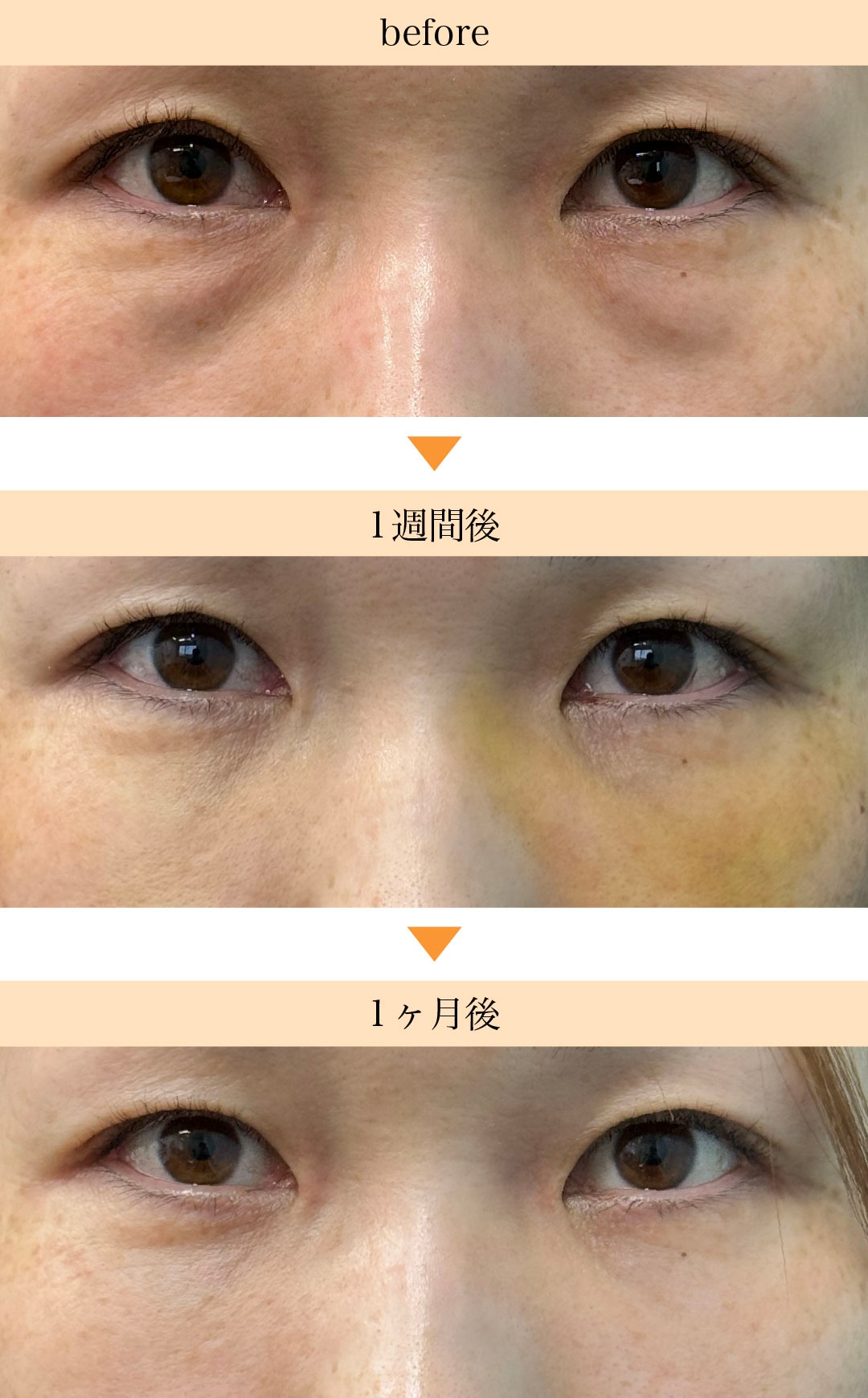 クマ取り＋脂肪注入