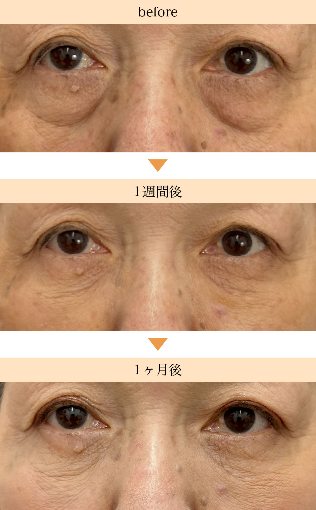 クマ取り＋脂肪注入