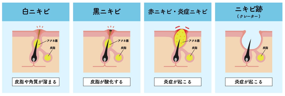 進行度別：ニキビの種類