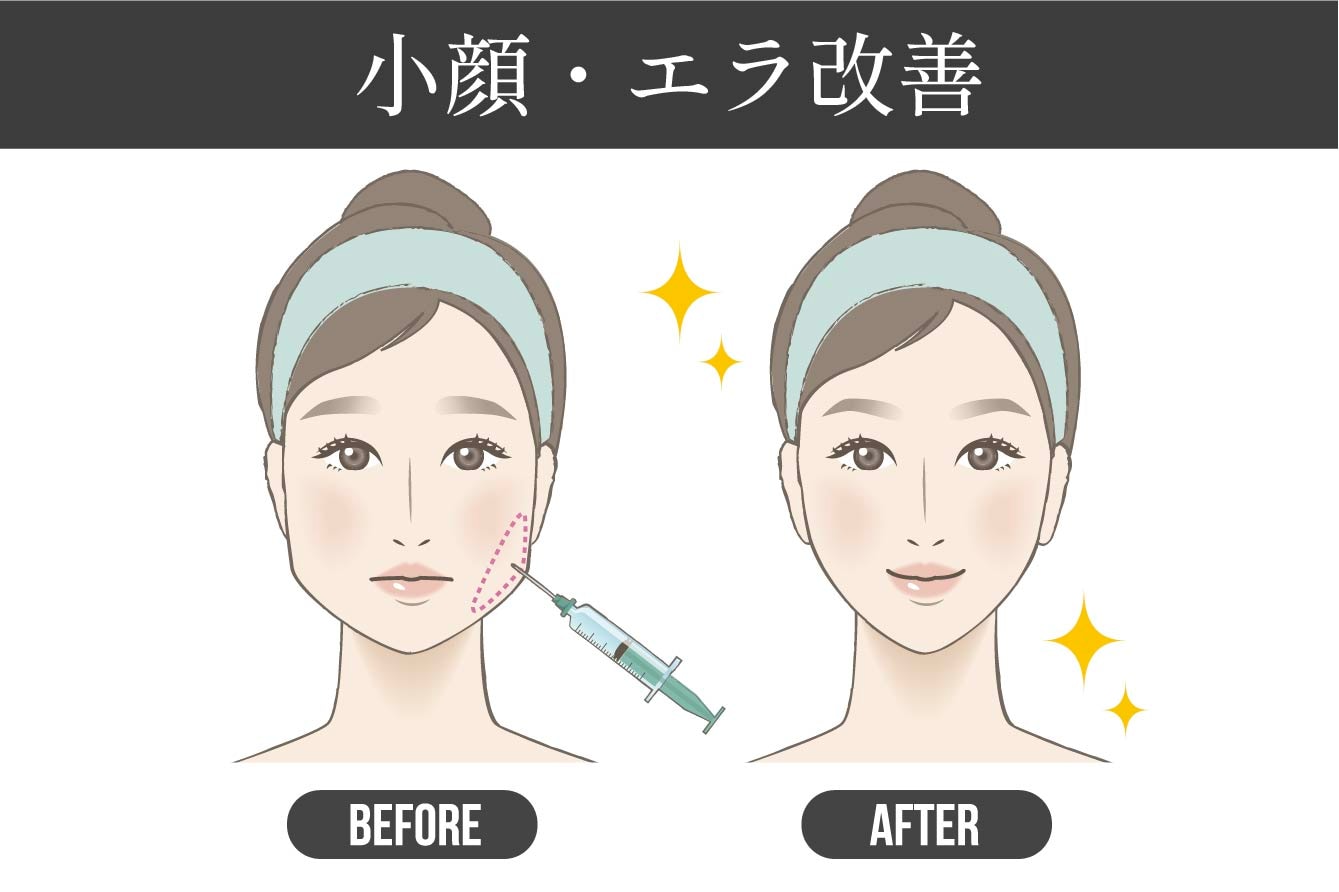 小顔・エラ改善