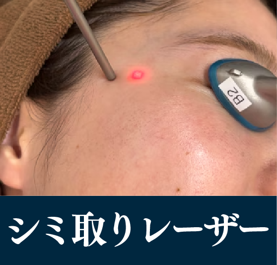 シミ取りレーザー