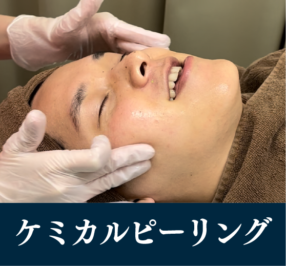 ケミカルピーリング