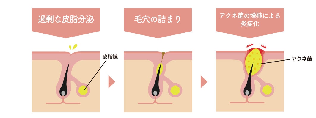 ニキビができる主な3つの原因