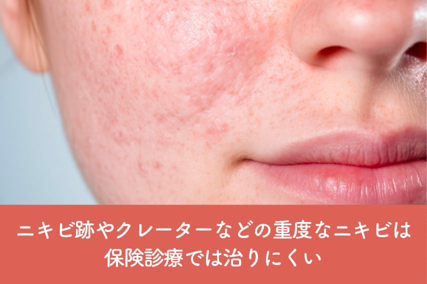 ニキビ跡やクレーター、重度のニキビは保険診療では治りにくい