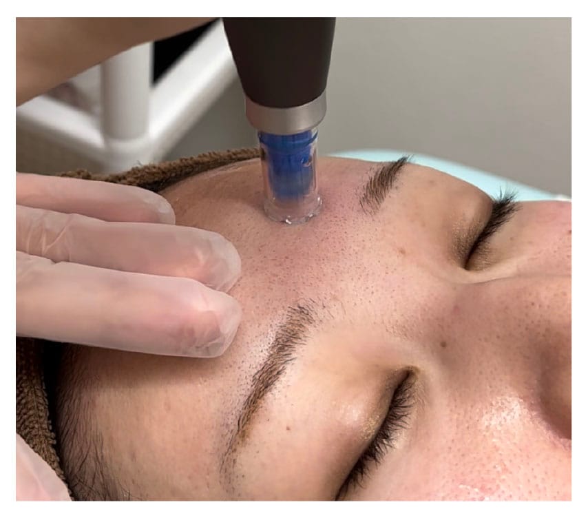 痛みやダウンタイムに配慮した様々な機械があるから