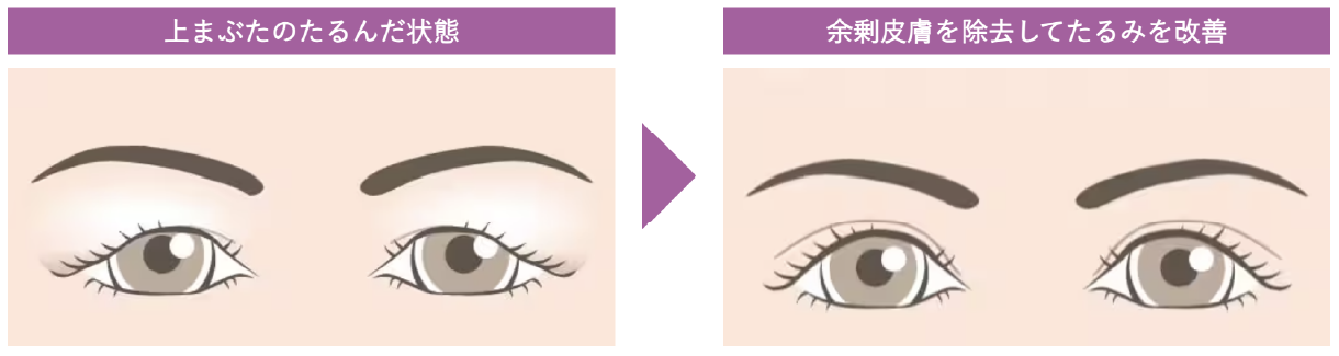眉下リフト(眉下切開)ってどんな施術？