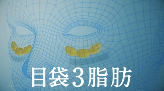 【目の下の切らないクマ・たるみ取り】とは
