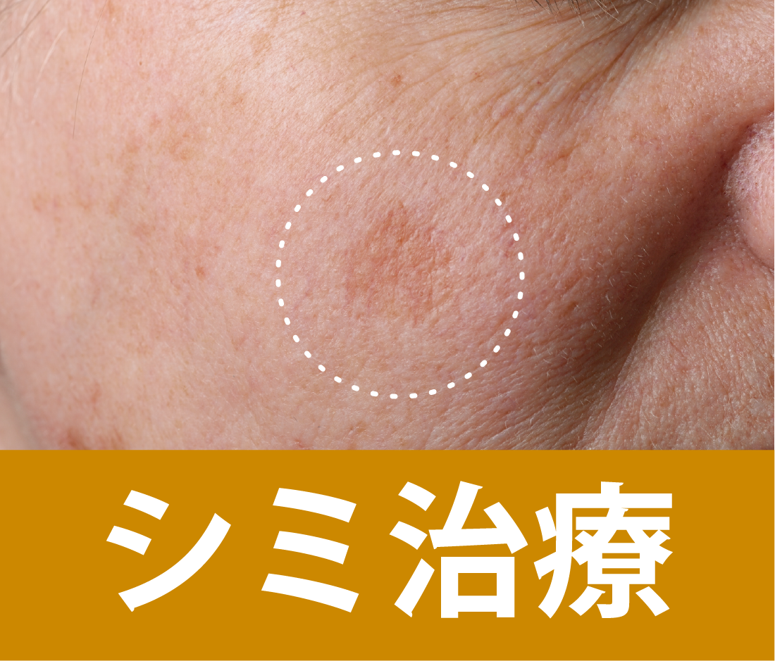 シミ治療