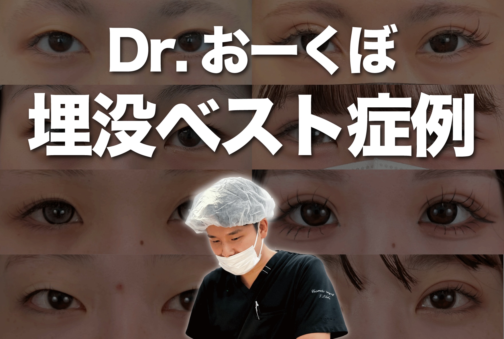 Dr.おーくぼの埋没症例集【秋田で埋没するならSBC秋田院】