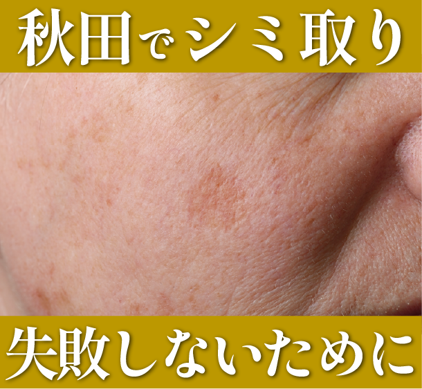 秋田でシミ取りを失敗しないためには？湘南美容クリニック秋田院でご相談を！