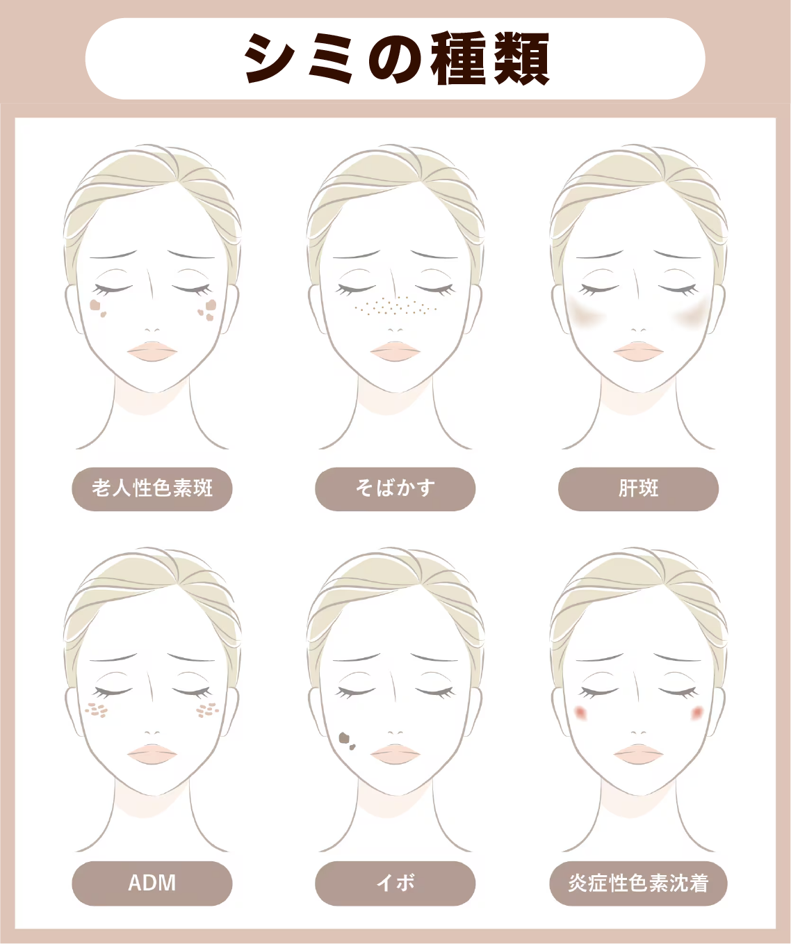 シミの種類は全部で6種類
