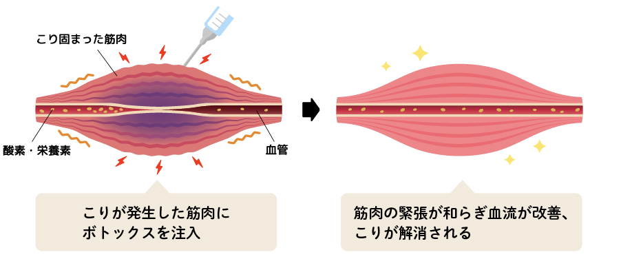 そもそもボトックス注射とは？