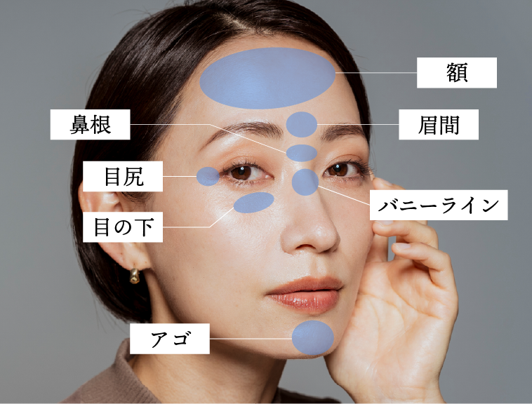 しわ取りボトックス・表情ジワの改善