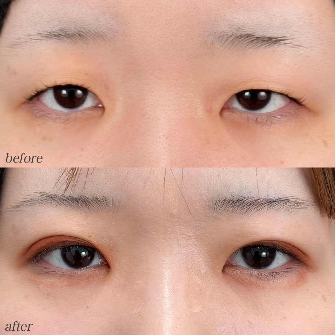 週末二重®︎＋自然癒着セット