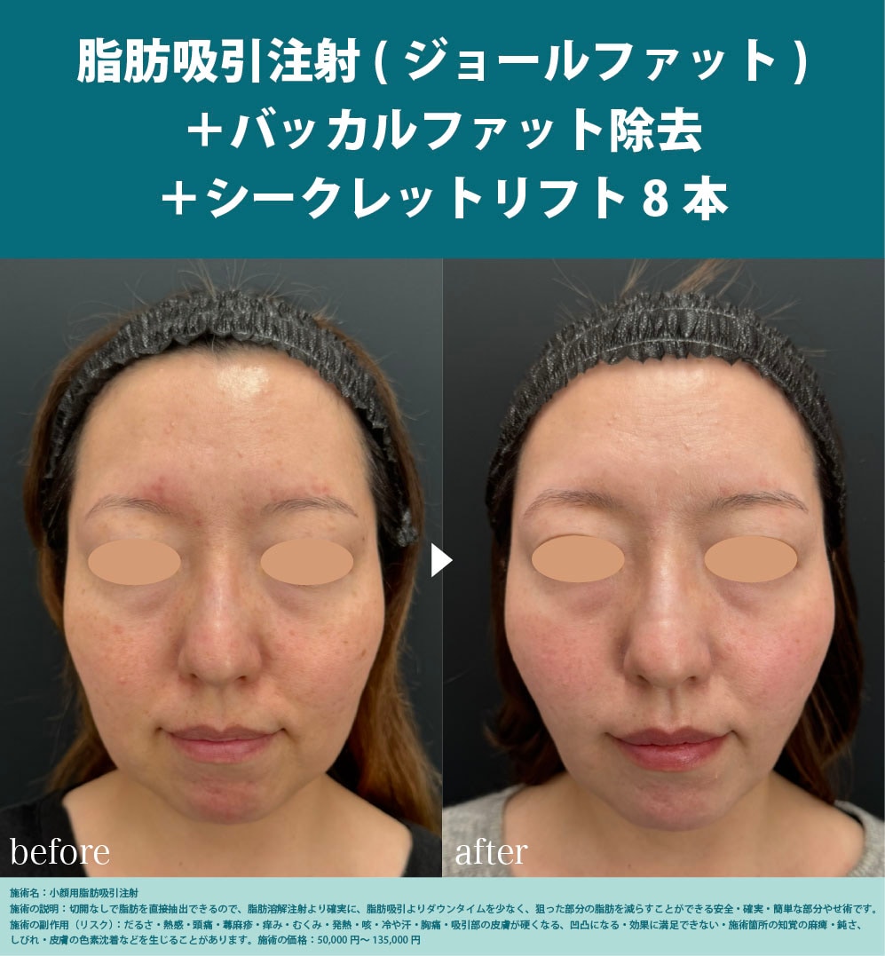 脂肪吸引注射(ジョールファット)<br />
＋バッカルファット除去<br />
＋シークレットリフト8本