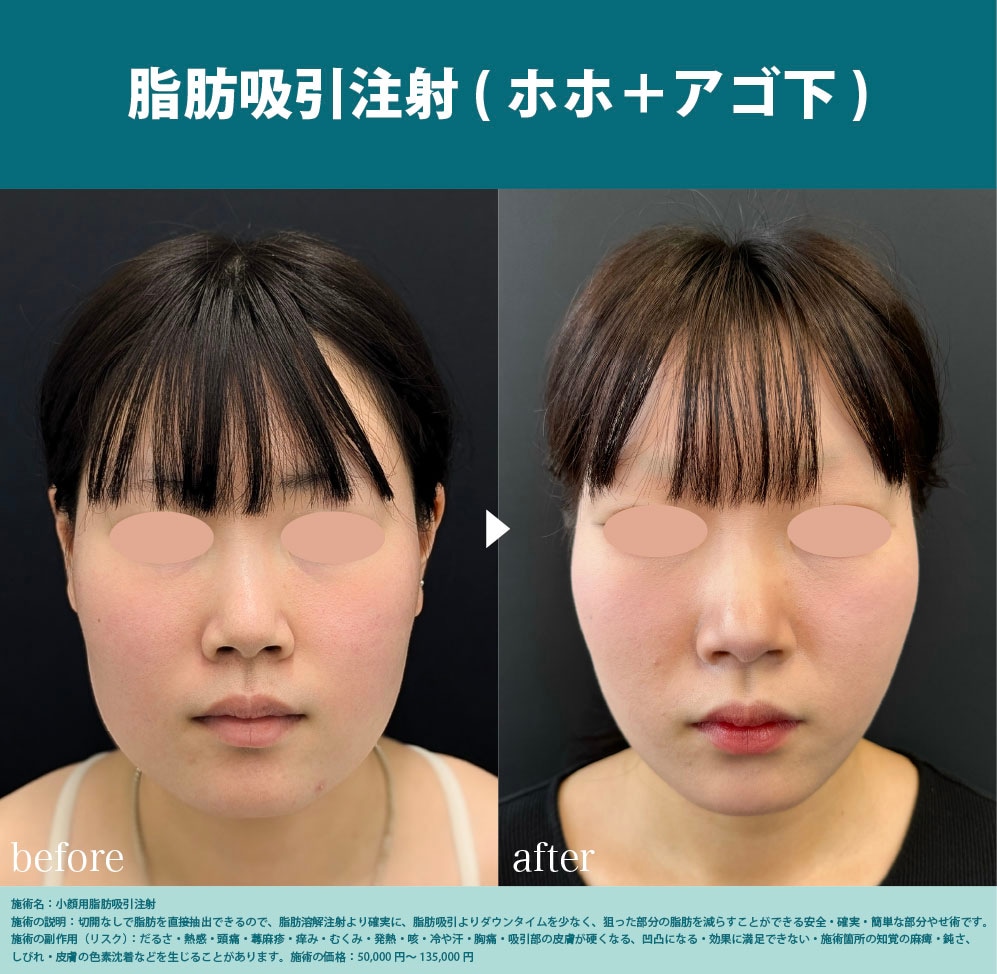 脂肪吸引注射(ホホ＋アゴ下)
