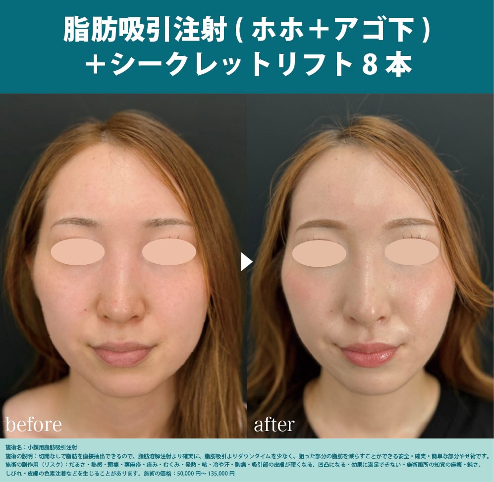 脂肪吸引注射(ホホ＋アゴ下)<br />
＋シークレットリフト8本
