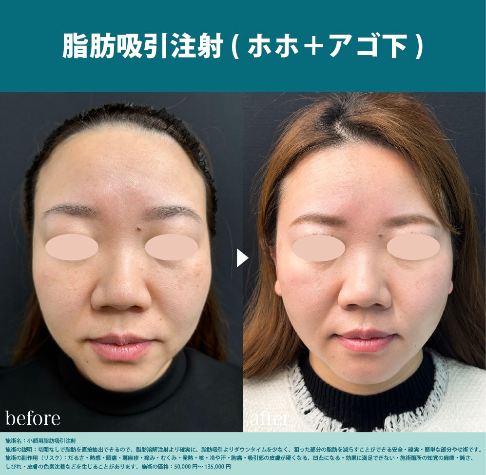 脂肪吸引注射(ホホ＋アゴ下)
