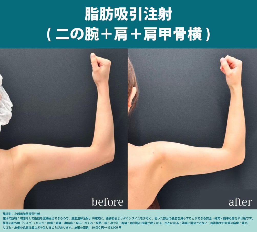 脂肪吸引注射(二の腕＋肩＋肩甲骨横)