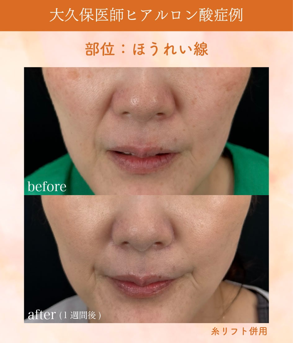 ほうれい線症例