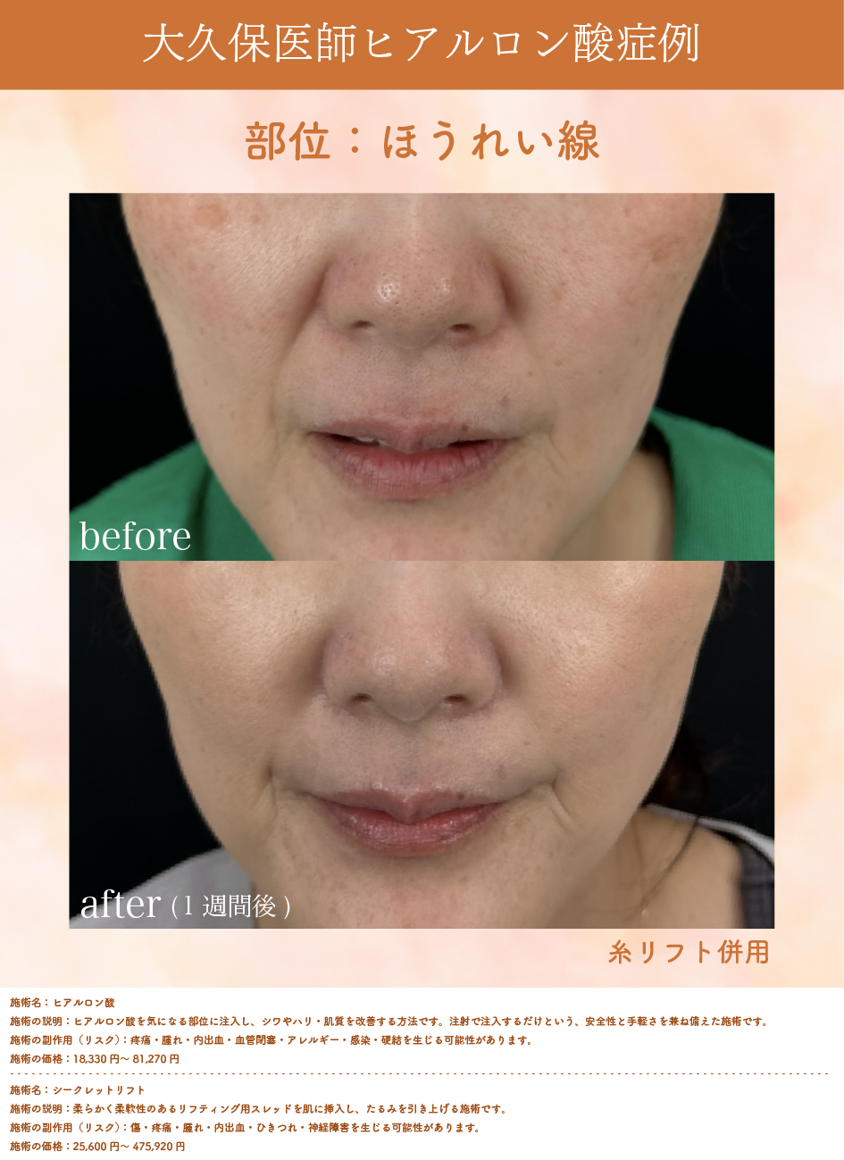 ほうれい線症例