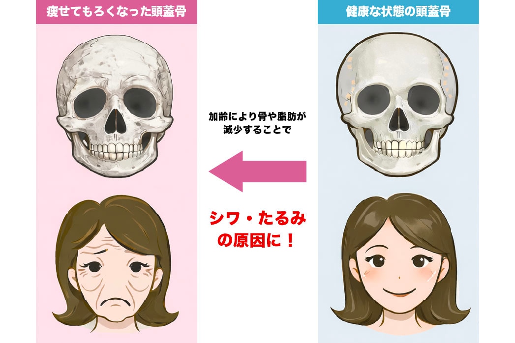 原因は「皮膚」ではなく「骨と脂肪の減少」