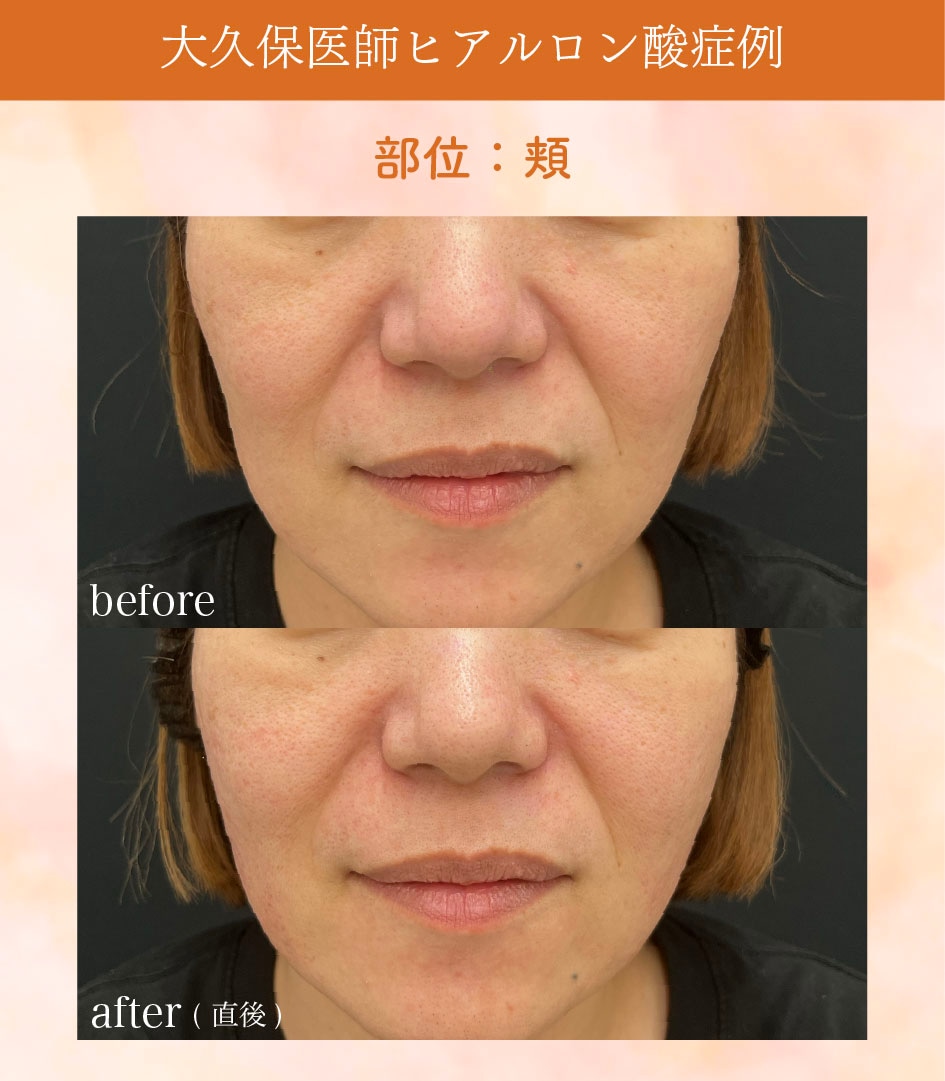 頬症例