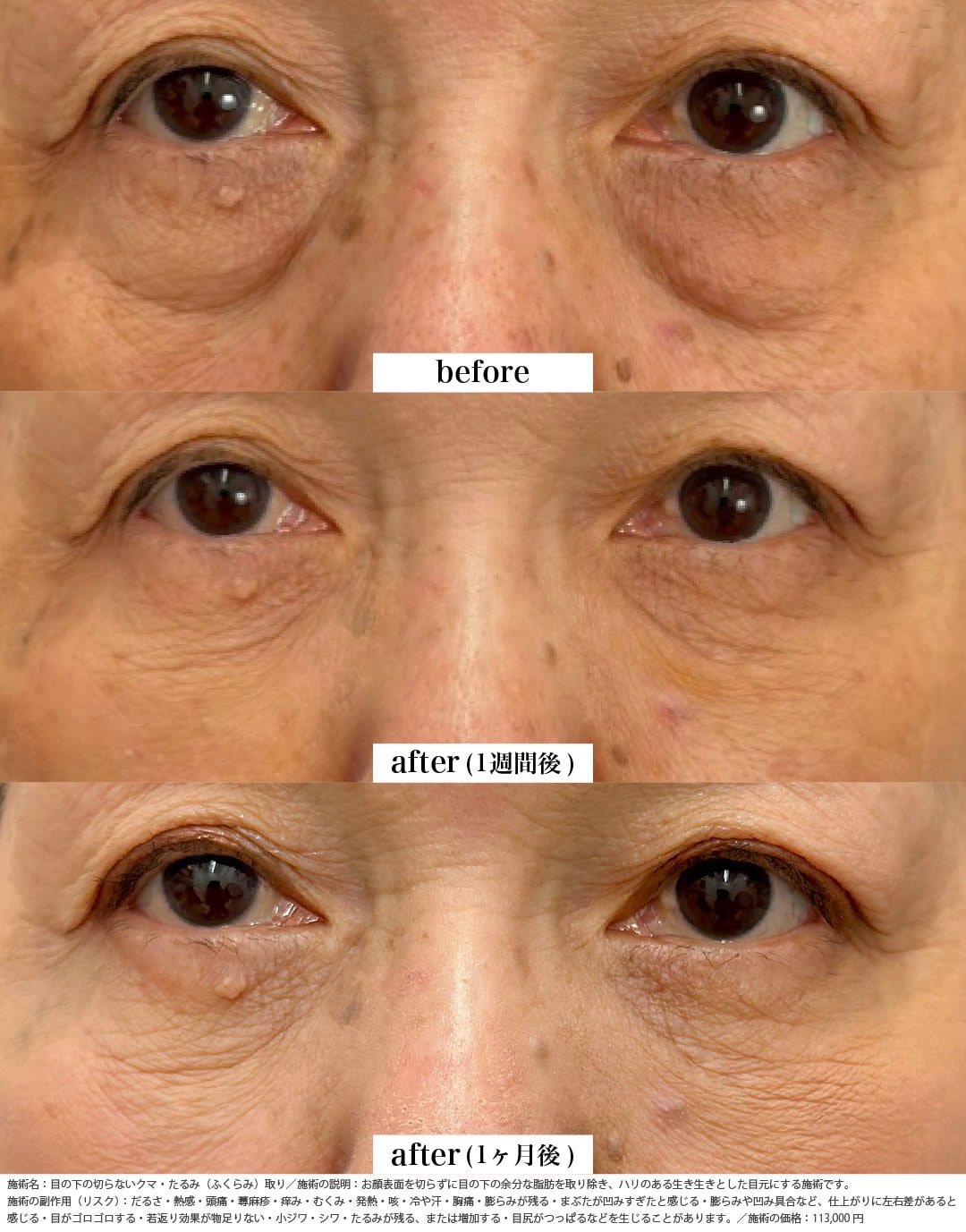 クマ取り＋脂肪注入