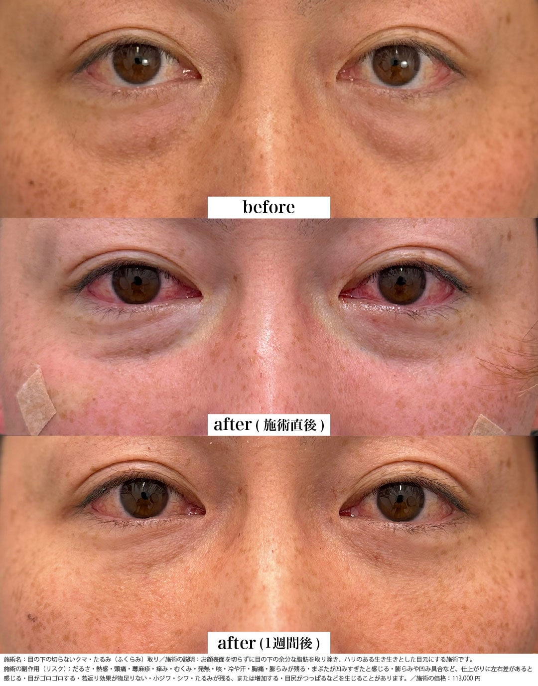 クマ取り＋脂肪注入