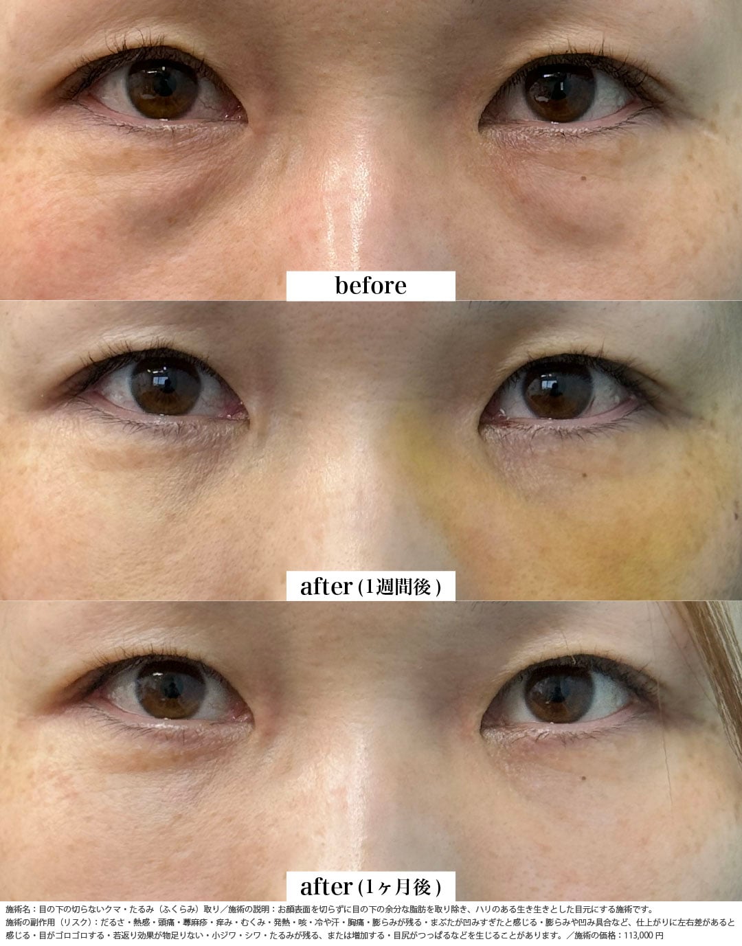 クマ取り＋脂肪注入