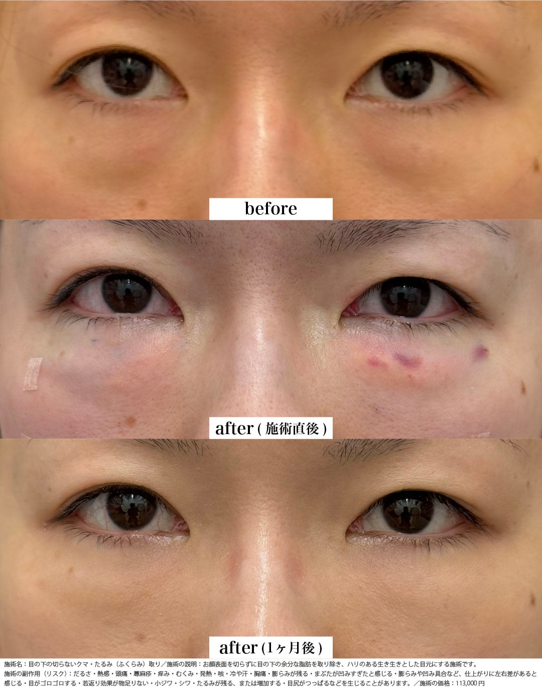 クマ取り＋脂肪注入