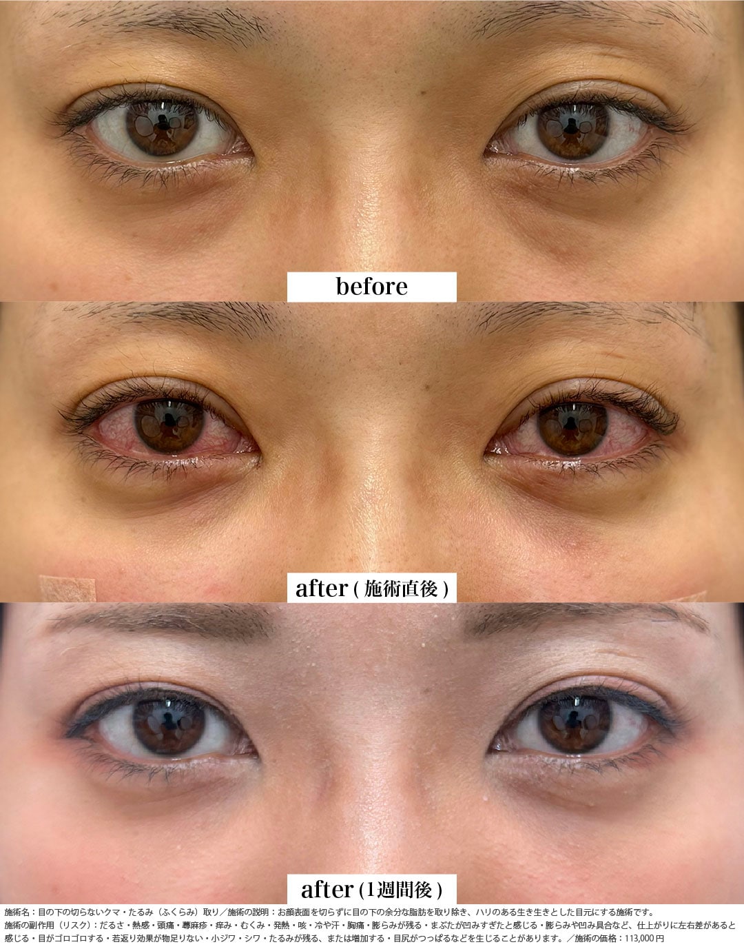 クマ取り＋脂肪注入