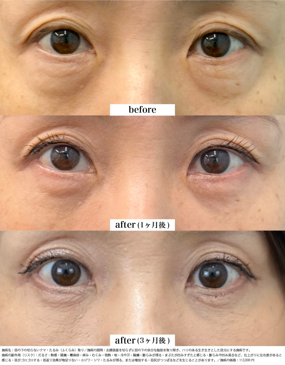 クマ取り＋脂肪注入