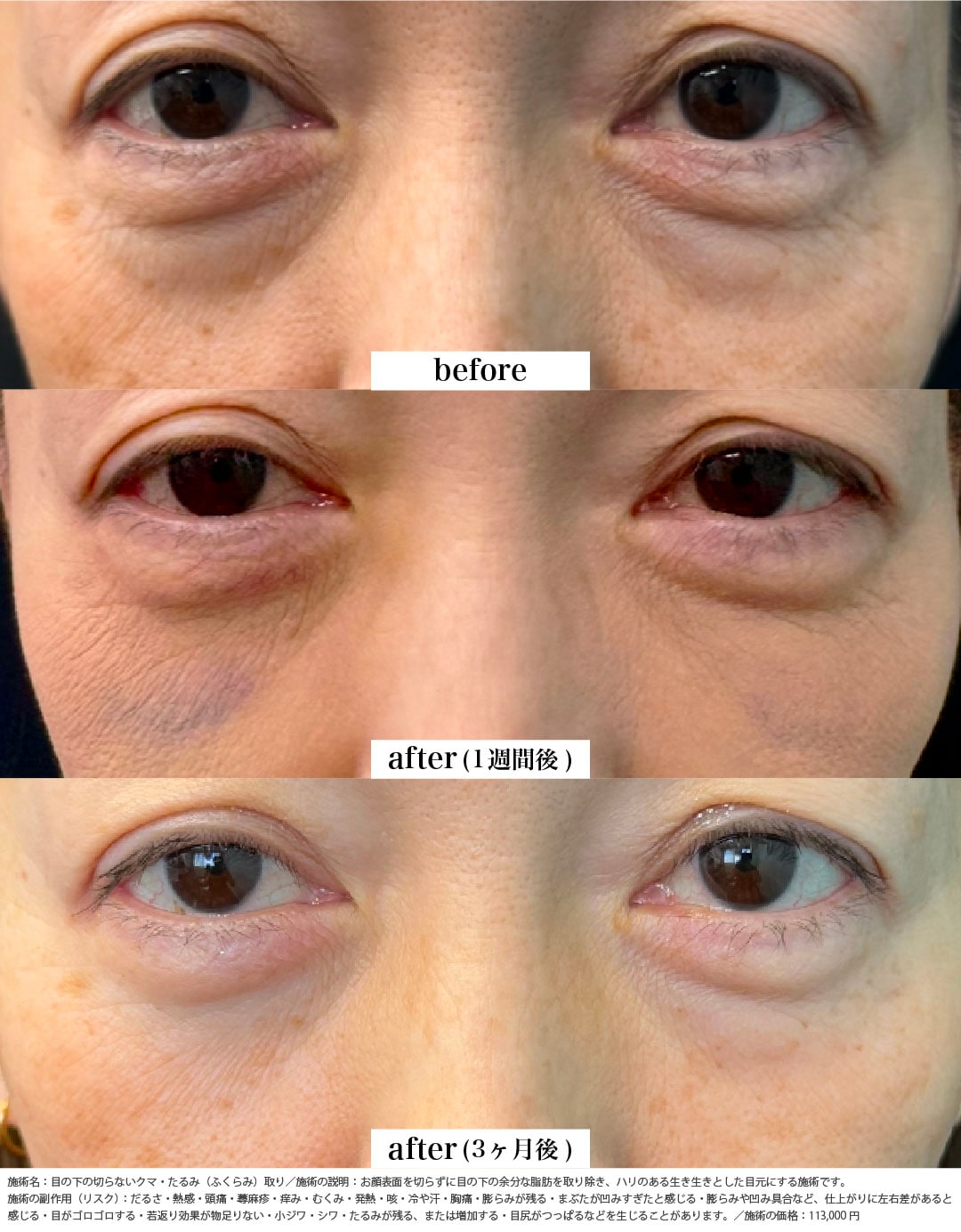 切らないクマ取り(脱脂のみ)