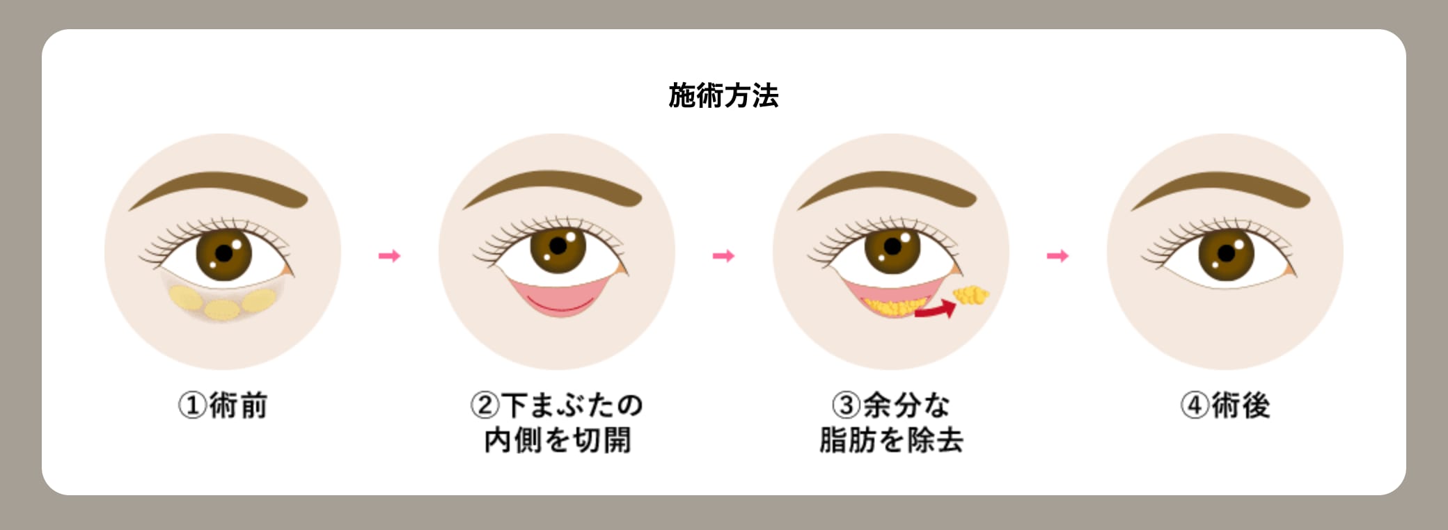 傷跡の心配がないクマ取り治療◎