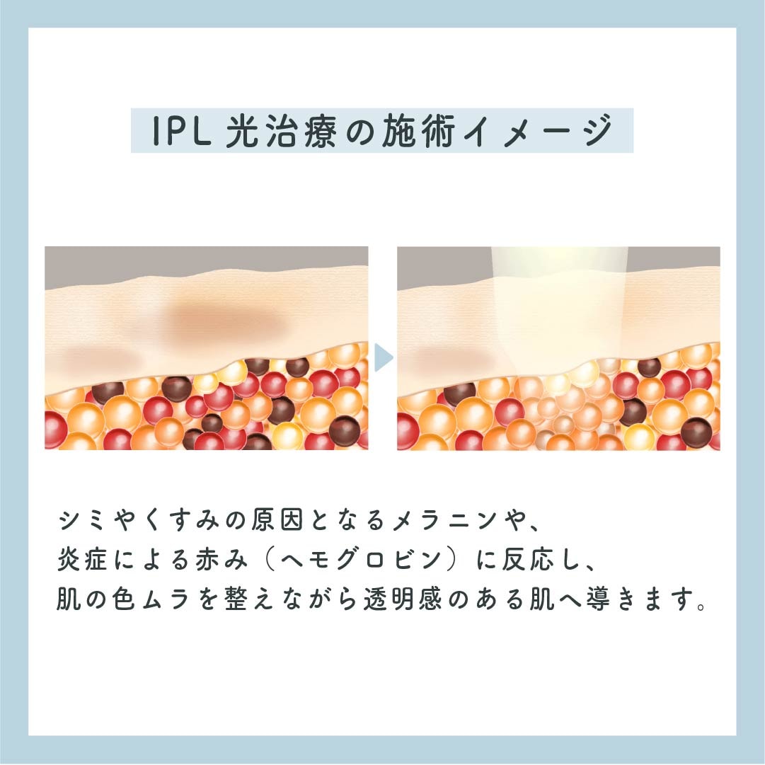 肌の奥に届く光で、気になる色ムラにアプローチ