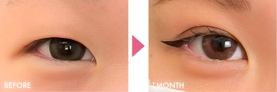 フォーエバー二重術®︎