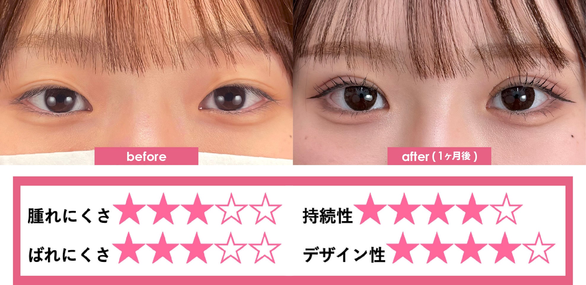 フォーエバー二重術®︎