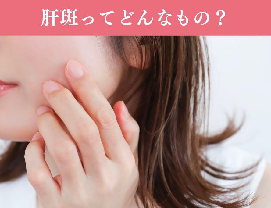 そもそも肝斑ってどんなもの？