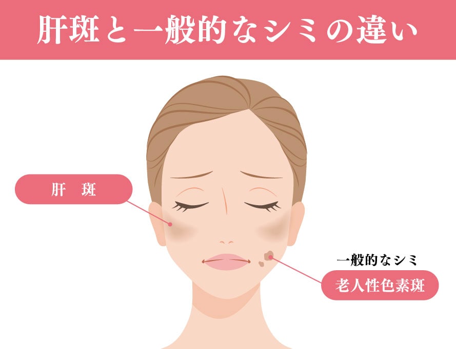 肝斑と一般的なシミの違い
