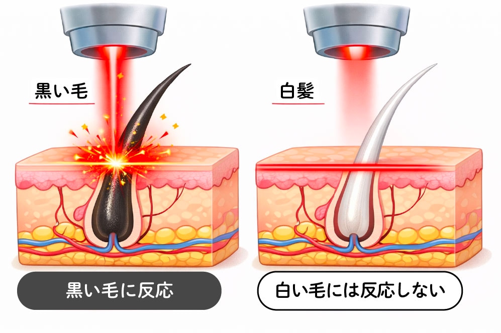 レーザーは「黒い色」に反応します