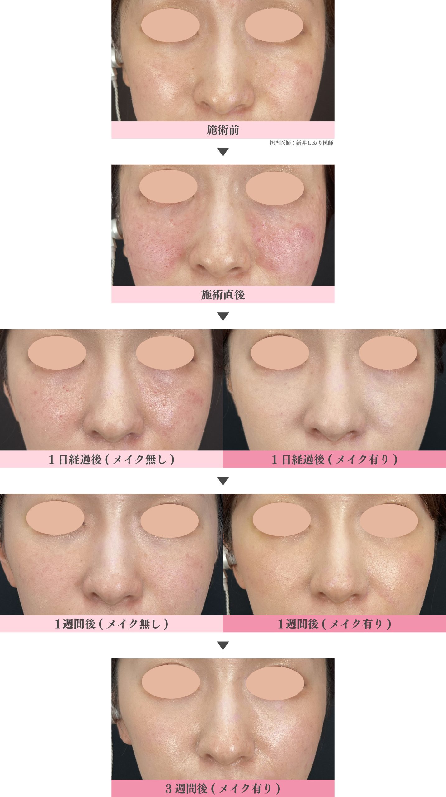 実際のダウンタイム経過