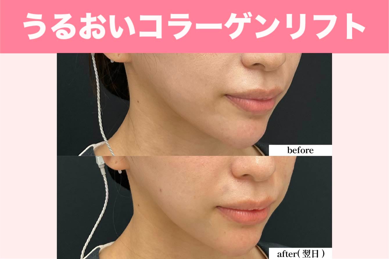 うるおいコラーゲンリフト