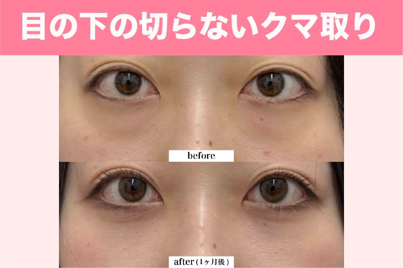 目の下の切らないクマ取り