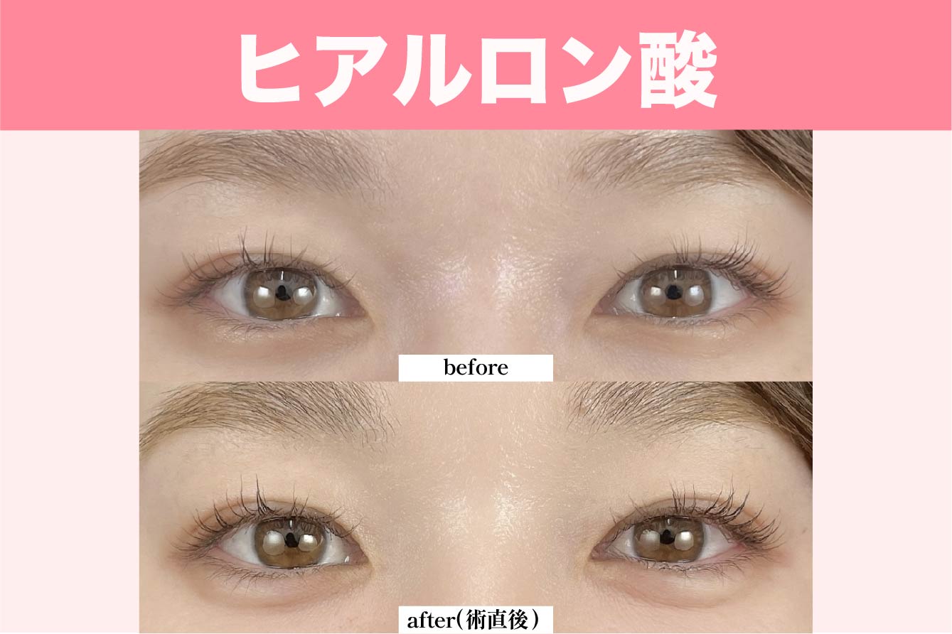ヒアルロン酸