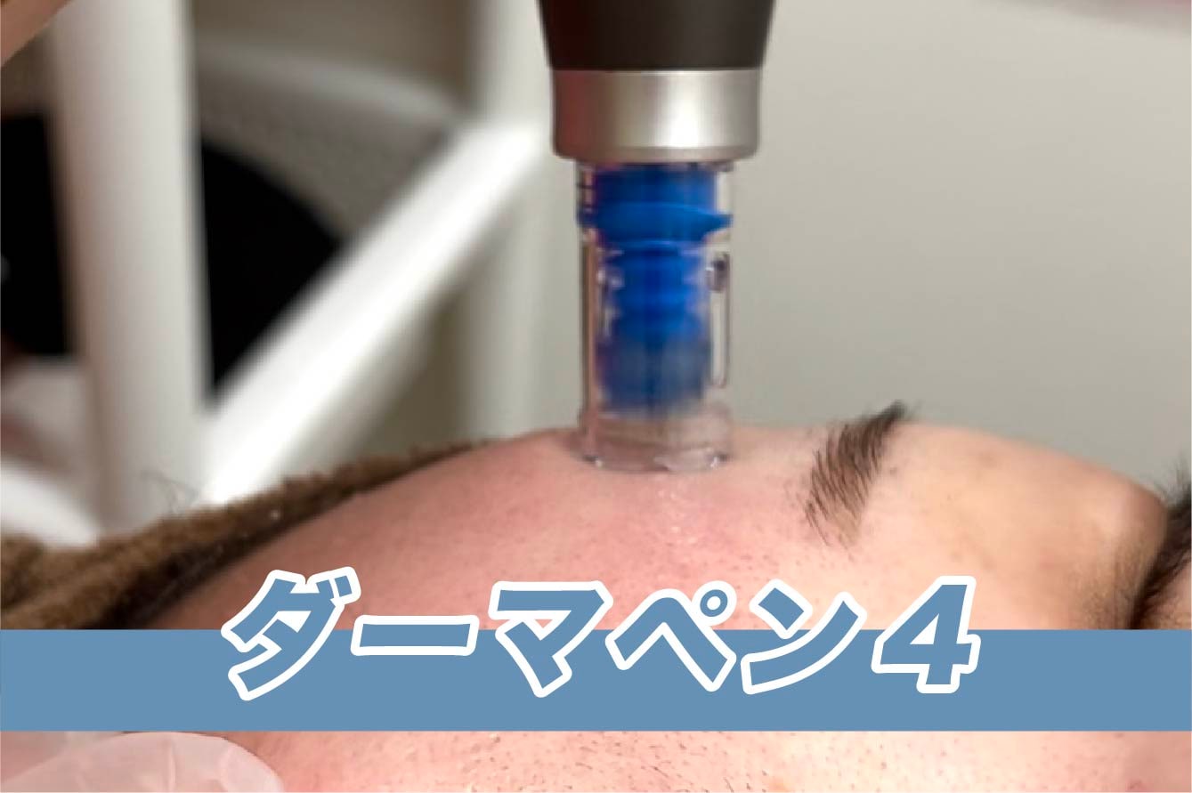 【ニキビ跡・毛穴】ダーマペン4
