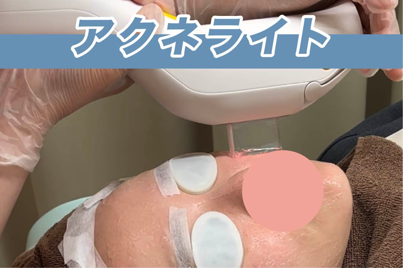 【ニキビ・ニキビ跡】アクネライト
