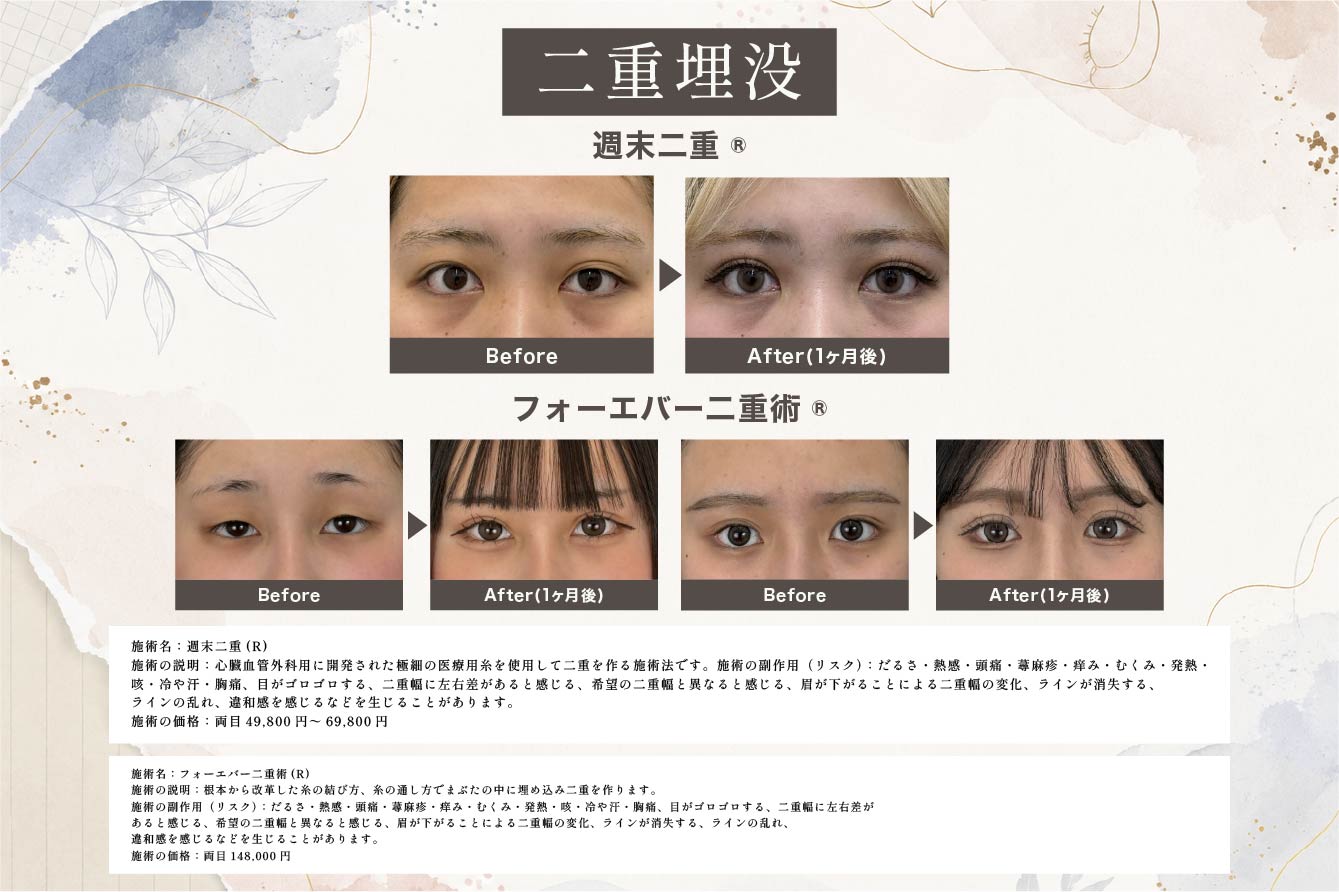 二重埋没法