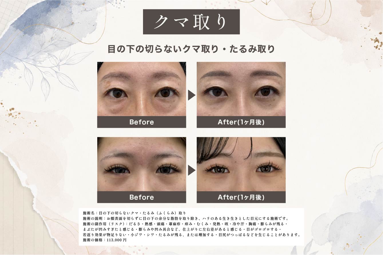 目の下の切らないクマ取り・たるみ（ふくらみ）取り